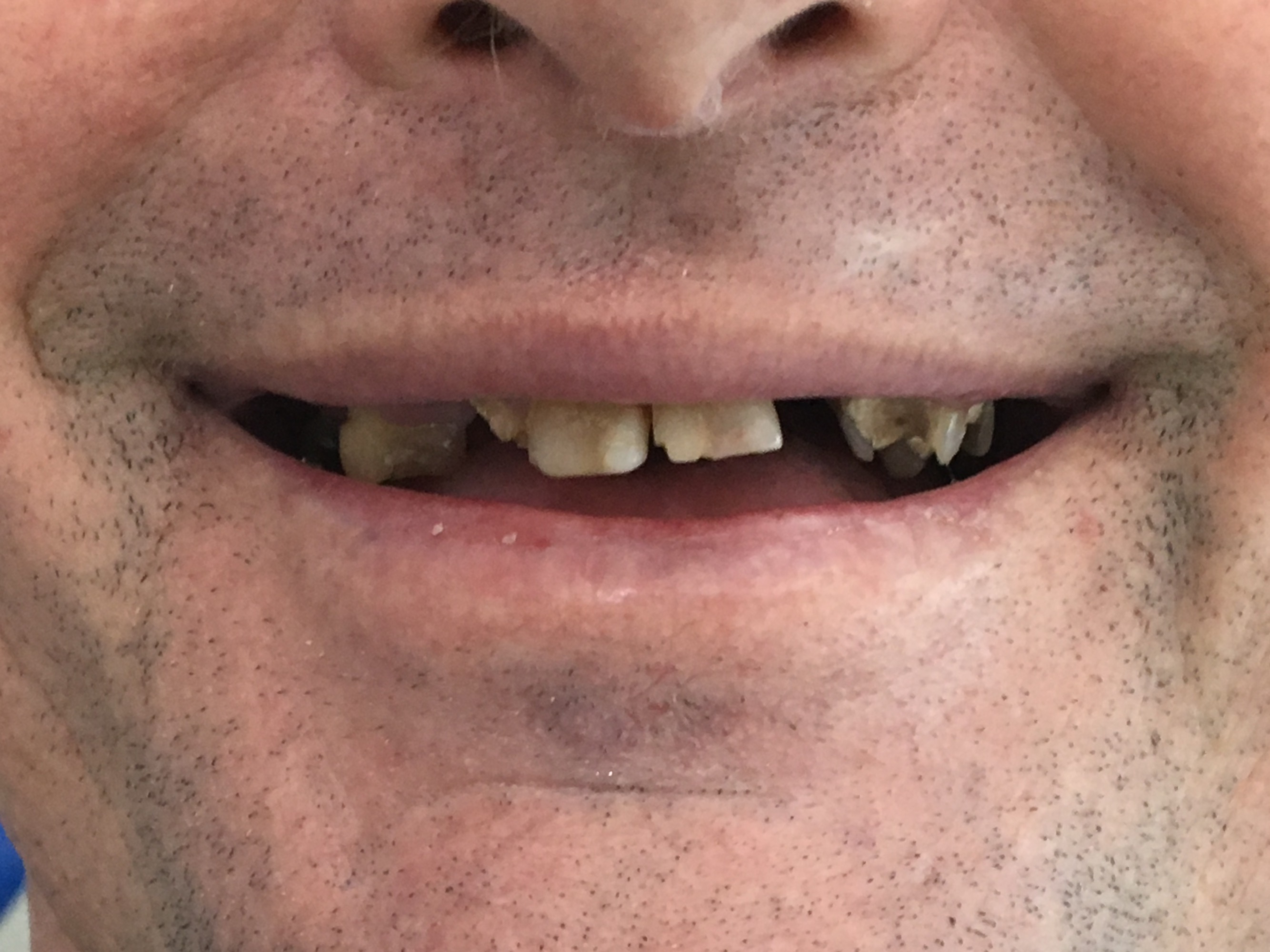 Review Implant Bangkok Dental Dentist Clinic By Bangkok Smile Dental 